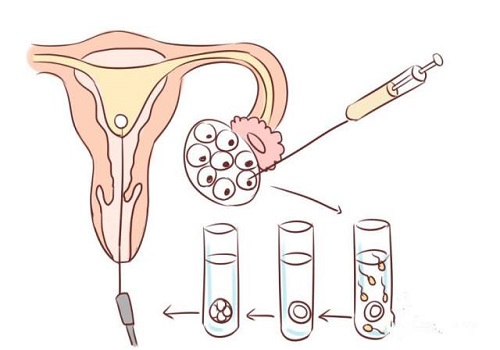 三代试管如何挑选精子？进行检查！